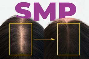 Микропигментация кожи головы (SMP): средства, оборудование, показания